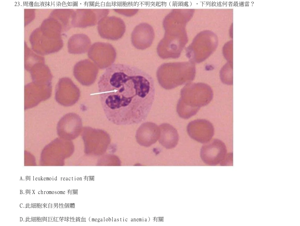 114年第2次醫事檢驗師國考 臨床血液學與血庫學 第23題原 PDF 題面截圖(含圖像、公式或選項):周邊血液抹片染色如圖,有關此白血球細胞核的不明突起物(箭頭處),下列敘述何者最適當?
