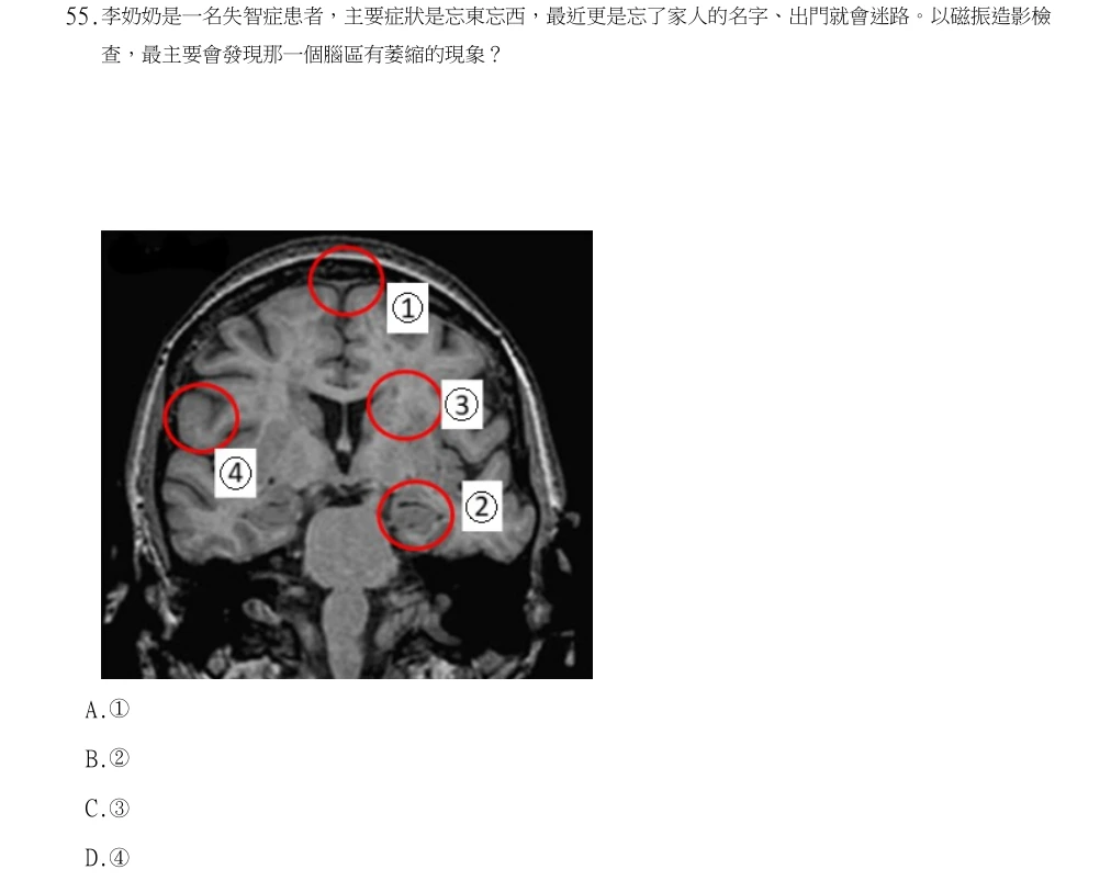 113年第2次物理治療師國考 神經疾病物理治療學 第55題原 PDF 題面截圖(含圖像、公式或選項):李奶奶是一名失智症患者,主要症狀是忘東忘西,最近更是忘了家人的名字、出門就會迷路。以磁振造影檢查,最主要會發現那一個腦區有萎縮的現象?