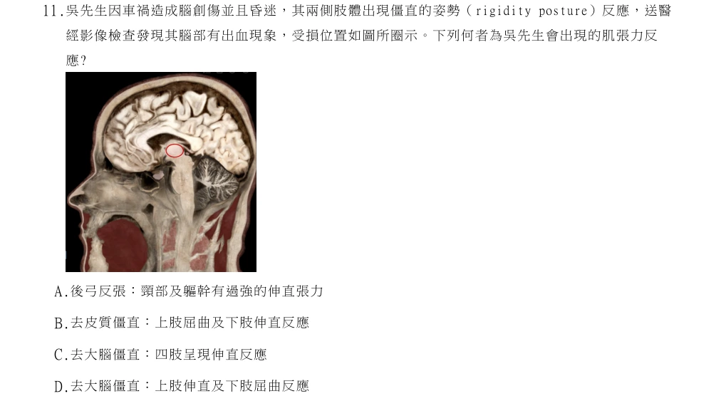 114年第1次物理治療師國考 神經疾病物理治療學 第11題原 PDF 題面截圖(含圖像、公式或選項):吳先生因車禍造成腦創傷並且昏迷,其兩側肢體出現僵直的姿勢(rigidity posture)反應,送醫經影像檢查發現其腦部有出血現象,受損位置如圖所圈示。下列何者為吳先生會出現的肌張力反應?