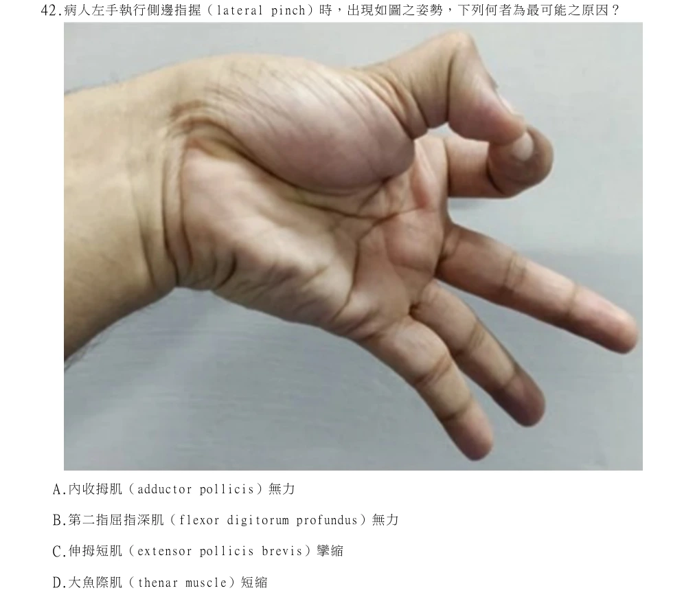 114年第1次物理治療師國考 骨科疾病物理治療學 第42題原 PDF 題面截圖(含圖像、公式或選項):病人左手執行側邊指握(lateral pinch)時,出現如圖之姿勢,下列何者為最可能之原因?