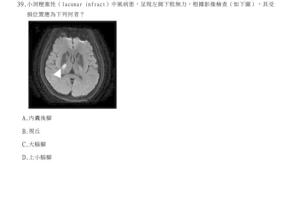 114年第2次物理治療師國考 神經疾病物理治療學 第39題原 PDF 題面截圖(含圖像、公式或選項):小洞梗塞性(lacunar infract)中風病患,呈現左側下肢無力,根據影像檢查(如下圖),其受損位置應為下列何者?